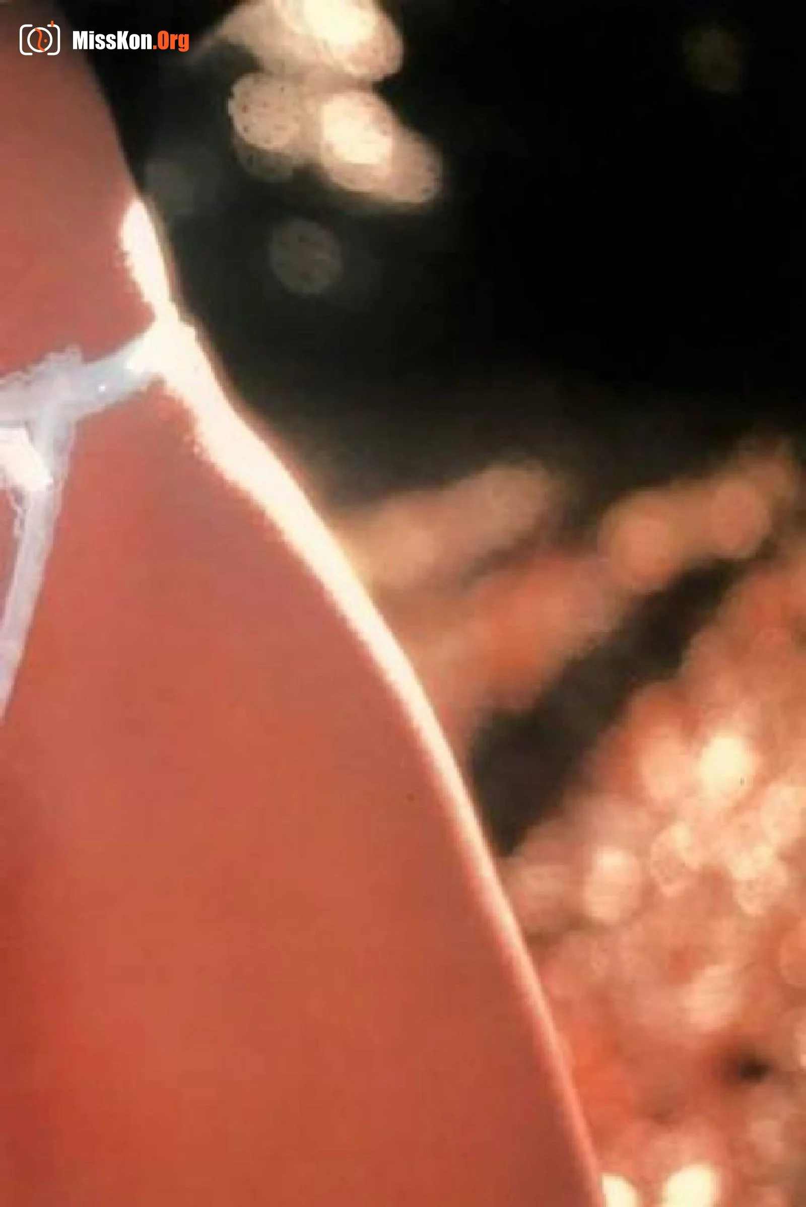 Muscle fold spasms (1981-01-01) - Photo 9